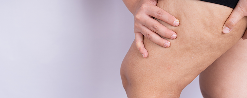 Close view of hand gripping leg with visible cellulite