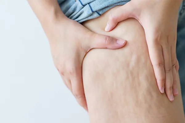 How to Reduce Cellulite in 2 Weeks: Top 6 Tips for Smoother Skin