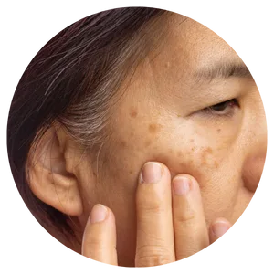 Sun Spots, Age Spots & Freckles