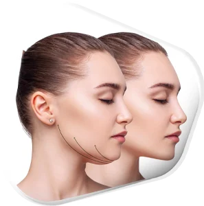 Under the Chin (Submental Fat)