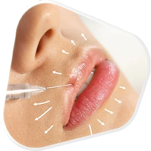 Lip Enhancement