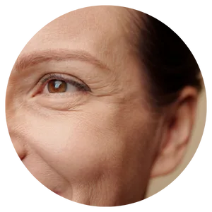 Upper Face Lines 