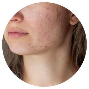 Post-Inflammatory Hyperpigmentation (PIH)