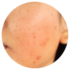 Melasma Management