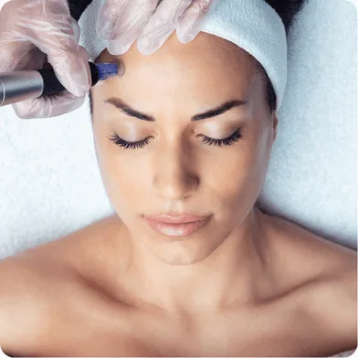 microneedling injection with elegant hoopoe in the UAE