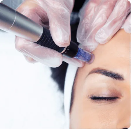 Skin treatment procedures using microneedling in the uae