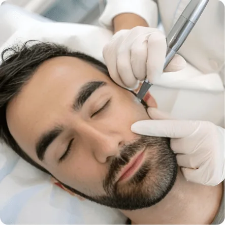 Microneedling treatment for skin rejuvenation at Elegant Hoopoe