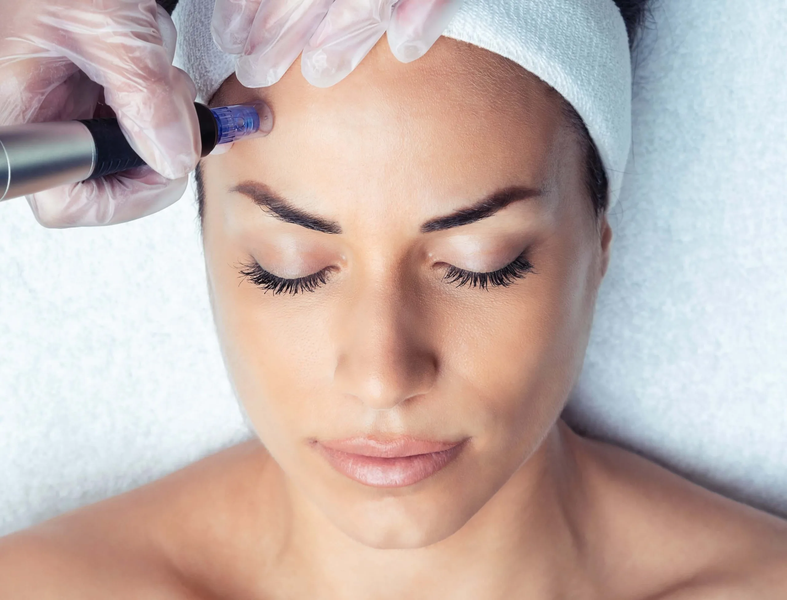microneedling injection with elegant hoopoe in the UAE